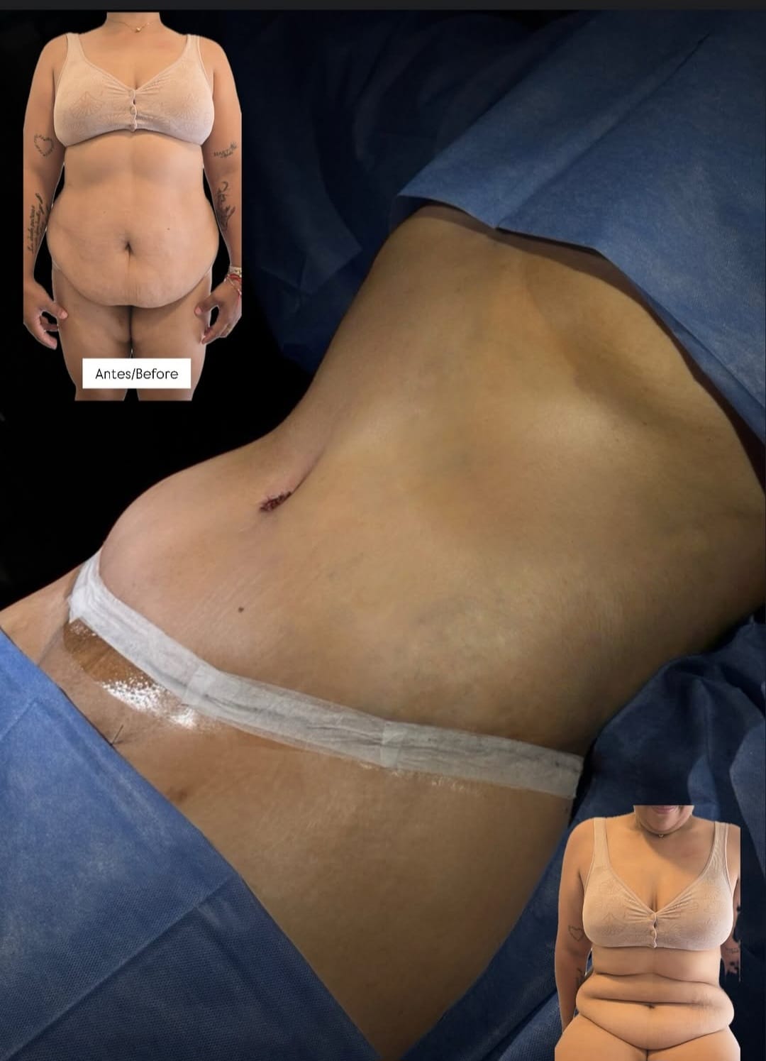 Dermolipectomía Circunferencial