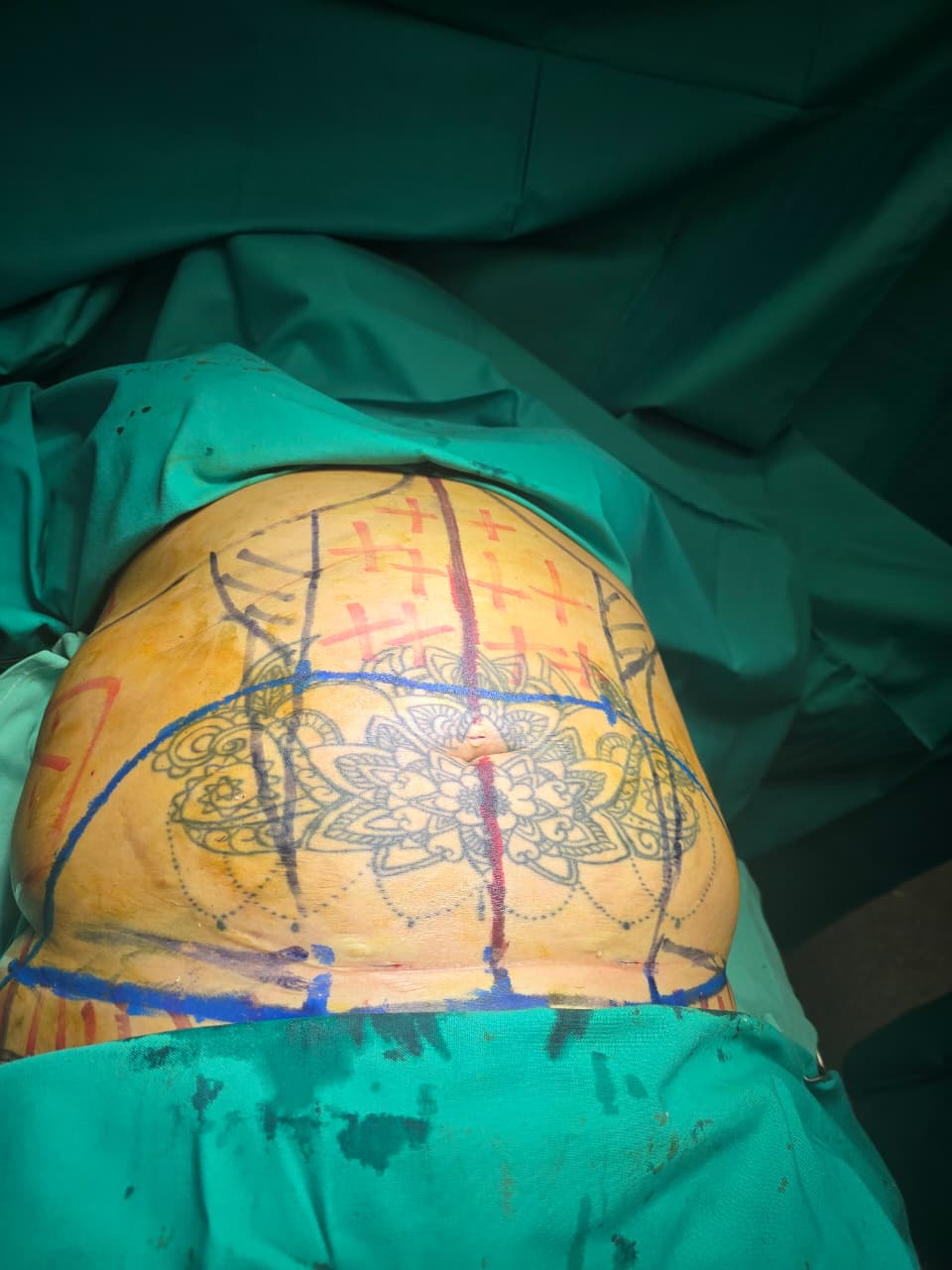 Antes Dermolipectomía