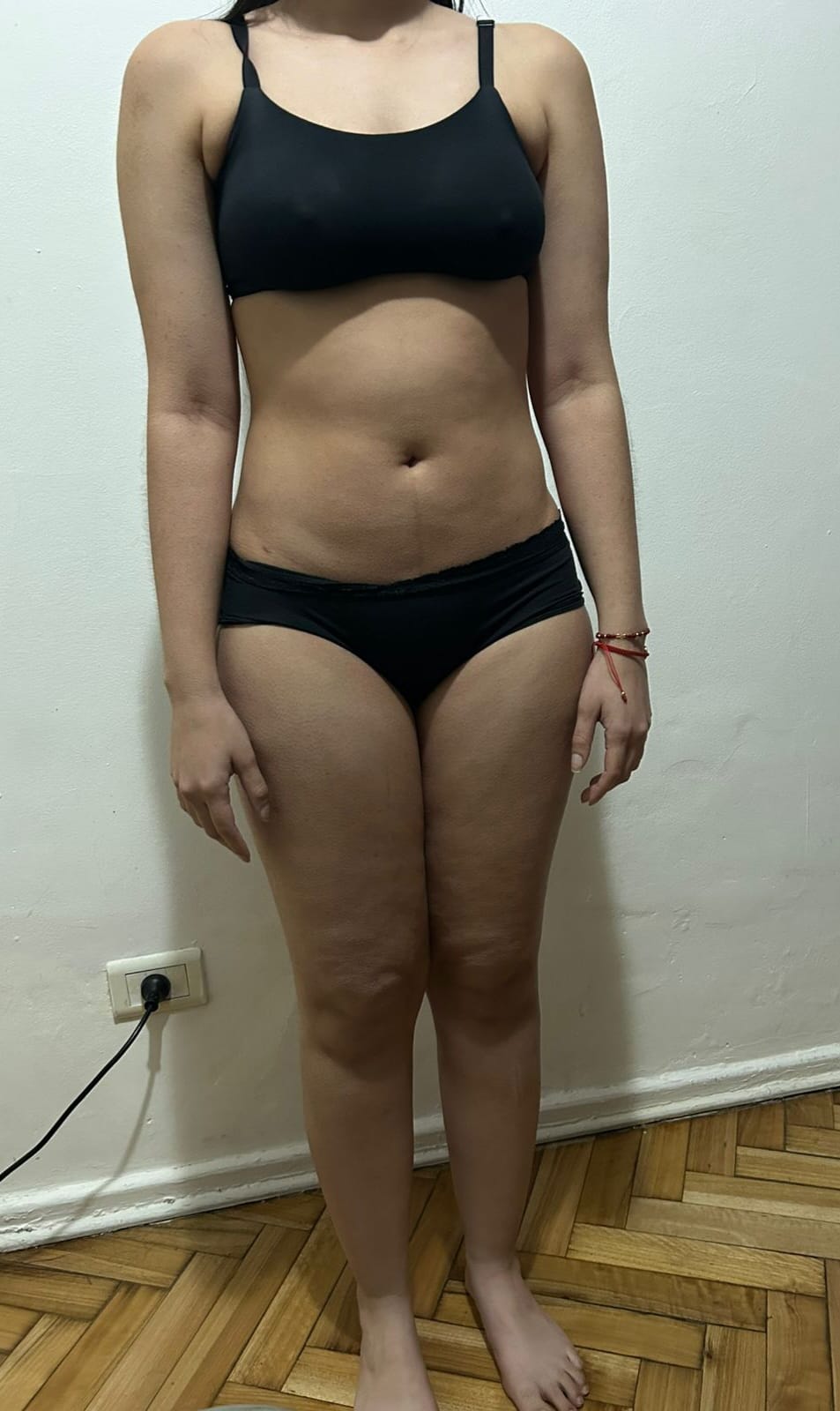 Antes Lipoescultura 360 con Marcación Soft